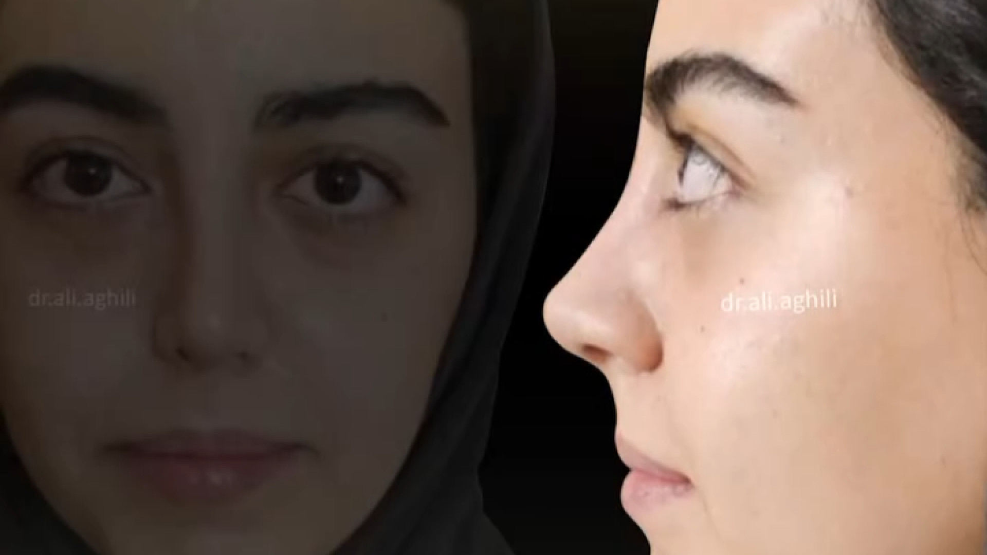 ️سپتو رینو پلاستی نچرال با قوس کم دکتر علی عقیلی - جراح بینی در تهران