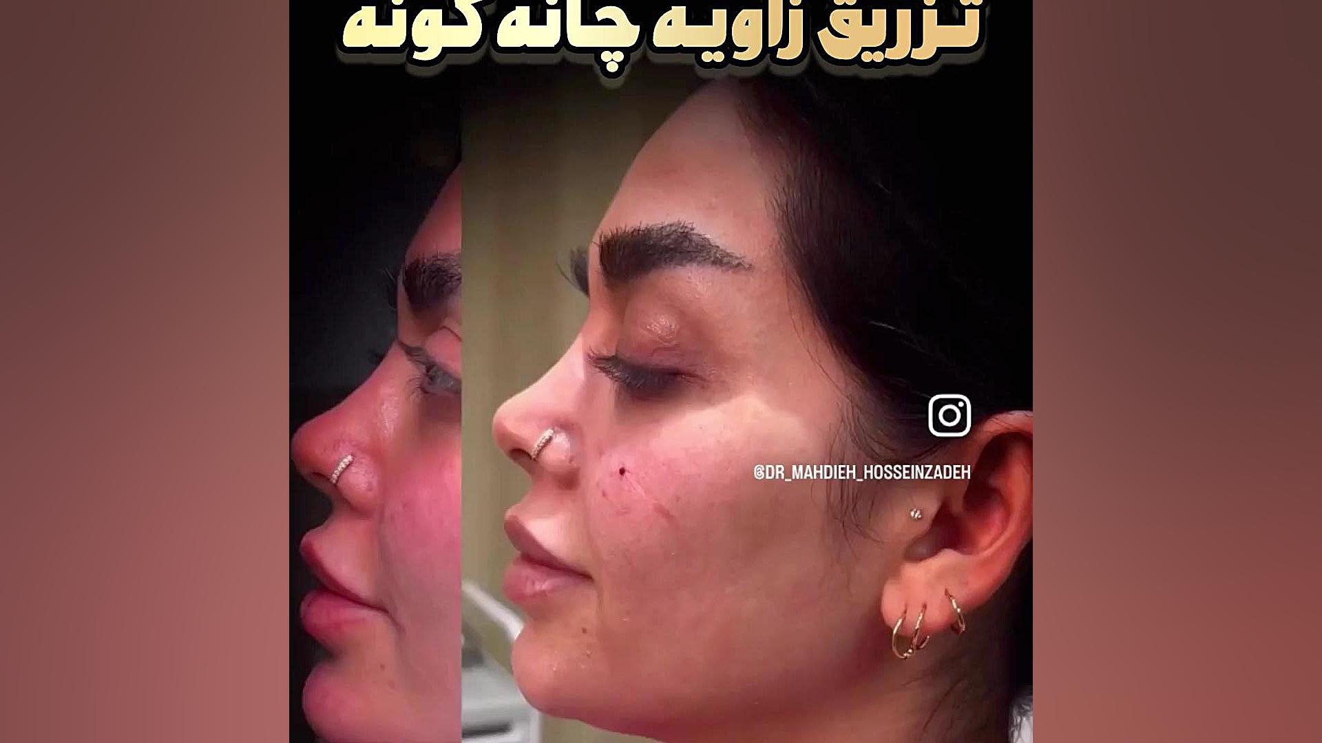 تزریق زاویه ، چانه ،گونه در بهترین کلینیک زیبایی رشت کلینیک زیبایی رشت دکتر مهدیه حسین زاده