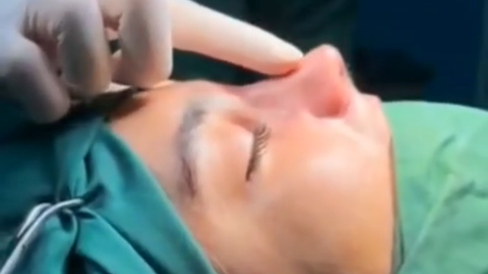 جراحی زیبایی بینی زیباجوی عزیزمون دکتر معصومه حسین پور