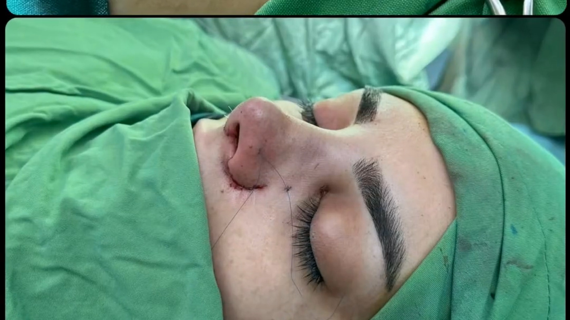 بلافاصله و یک هفته بعد از جراحی بینی دکتر معصومه حسین پور
