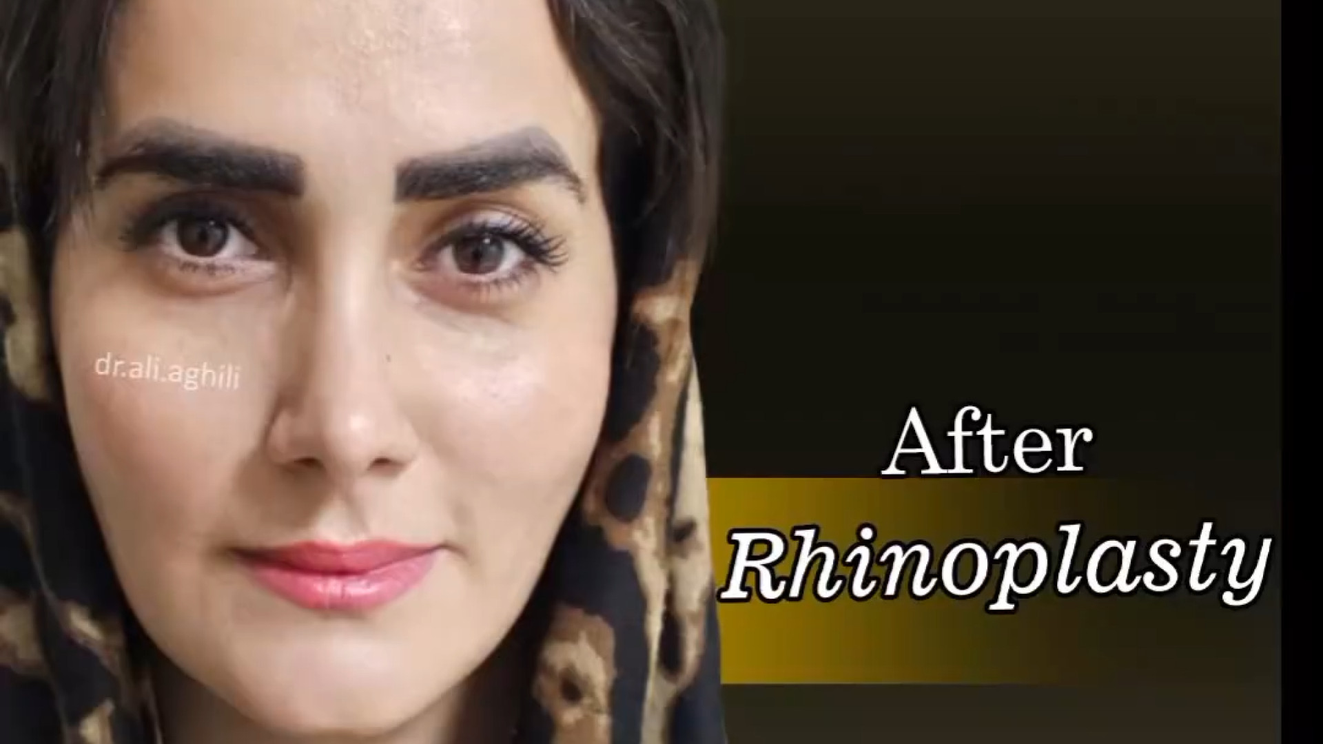 نوع بینی : استخوانی و با انحراف , ️در خواست زیباجو نچرال استاتیک دکتر علی عقیلی - جراح بینی در تهران