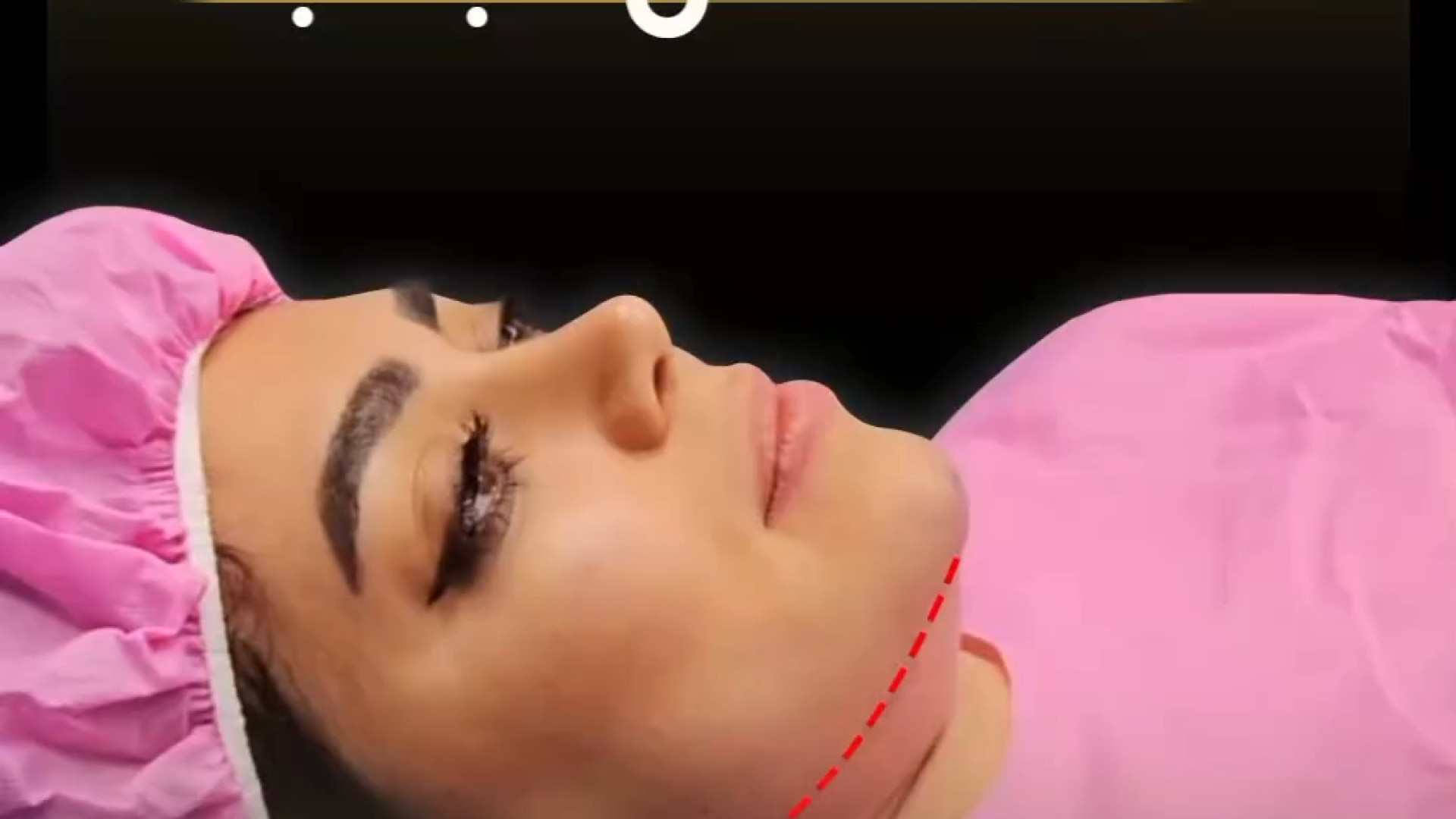 ساکشن غبغب 1 سال بعد از عمل رینوپلاستی دکتر علی عقیلی - جراح بینی در تهران