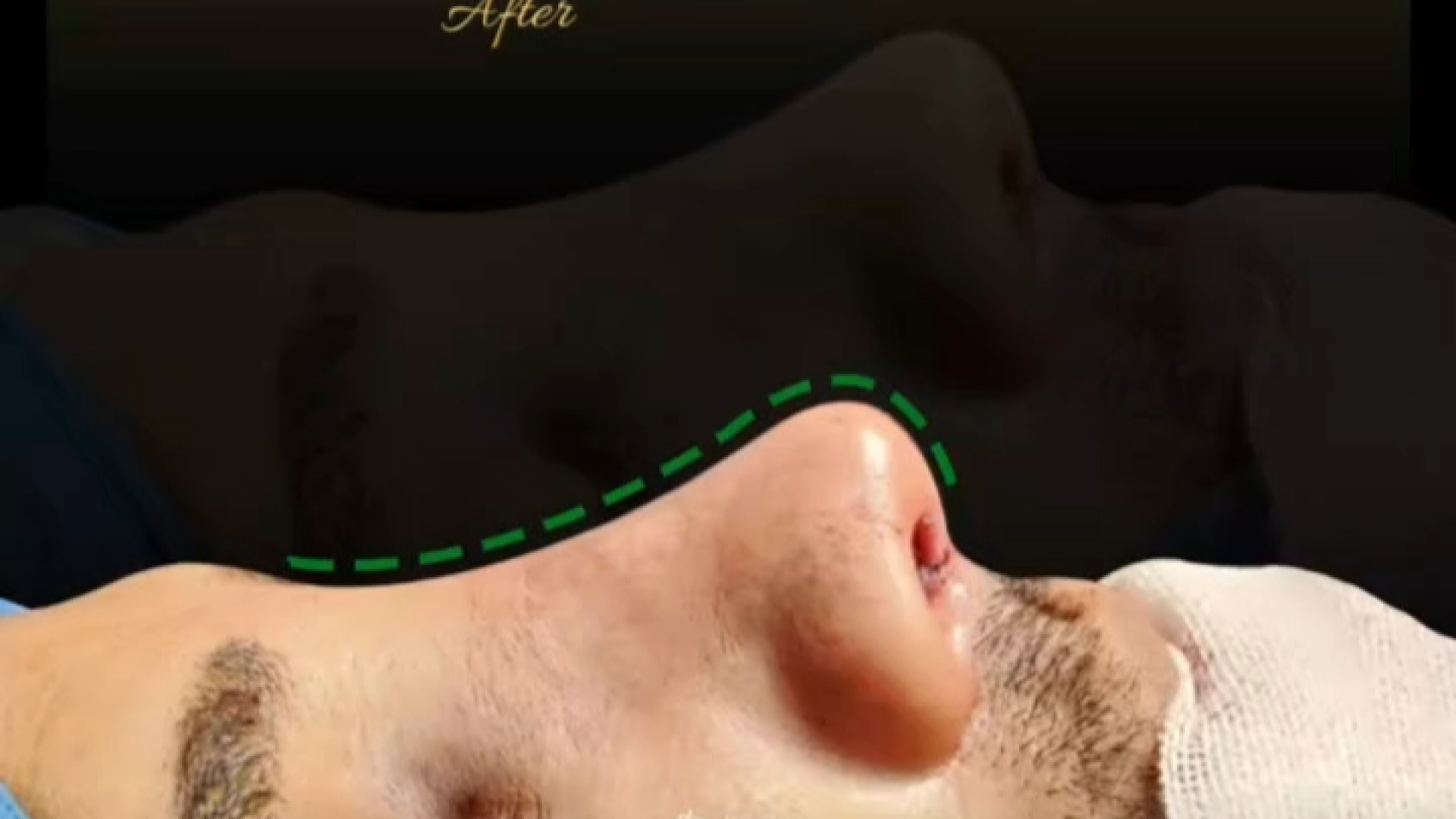 ️سپتو رینو پلاستی با انحراف و افتادگی زیاد , ️درخواست : بینی نیمه فانتزی دکتر علی عقیلی - جراح بینی در تهران