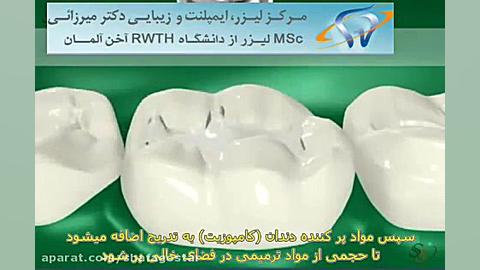 روش پر کردن دندان کلونیک اسپاسم
