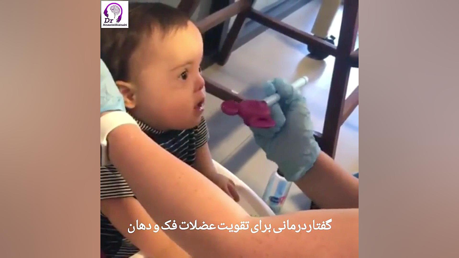 گفتاردرمانی در سندرم داون کاردیومگالی
