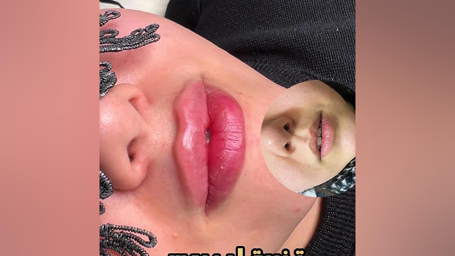 بهترین کلینیک زیبایی رشت /دکتر مهدیه حسین زاده تزریق لبروسی کلینیک زیبایی رشت دکتر مهدیه حسین زاده