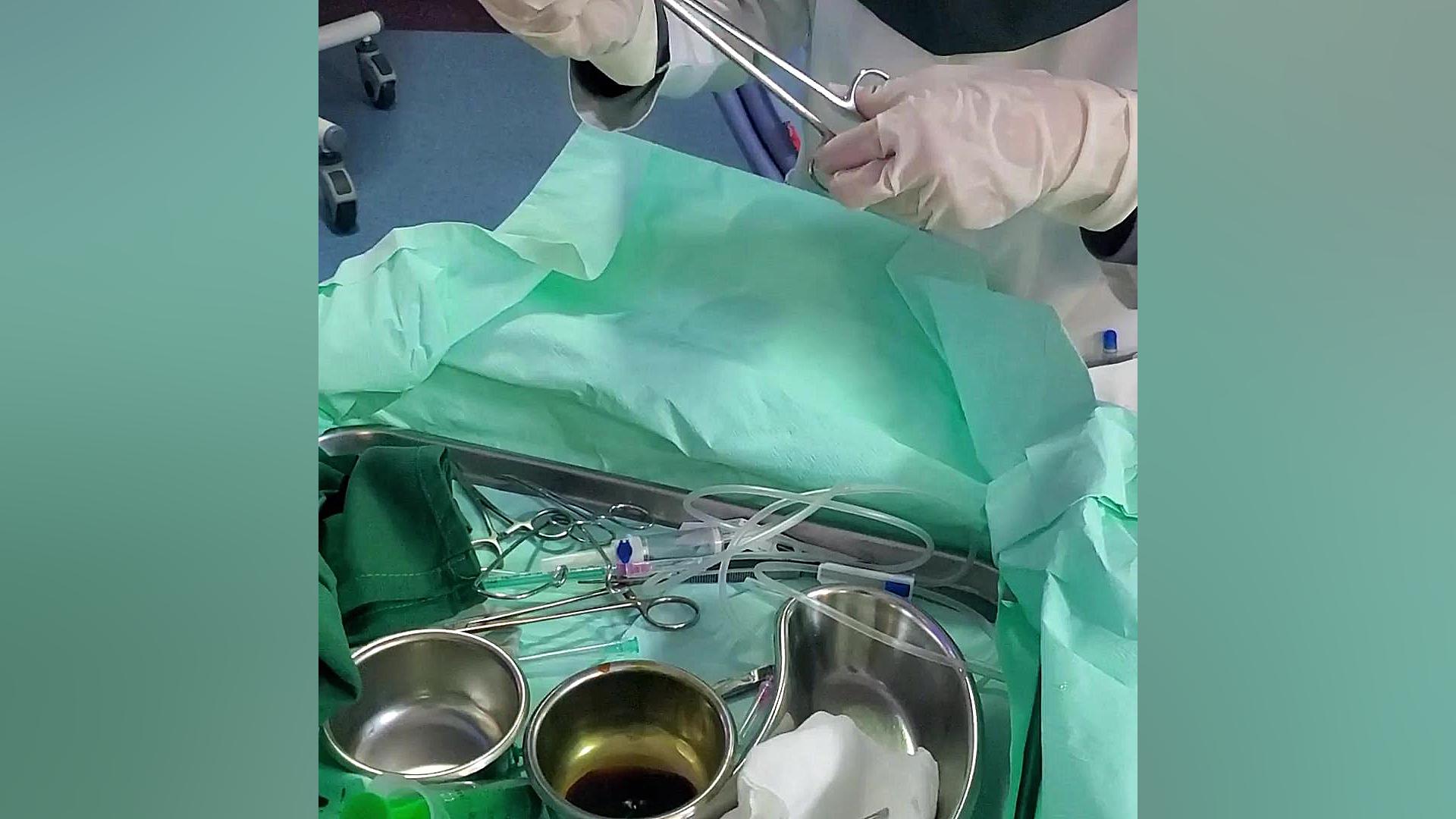قسمت سوم:آموزش دیالیز صفاقی آسان و با امکانات اولیه درنوزادان و کودکان اندودنتیکس