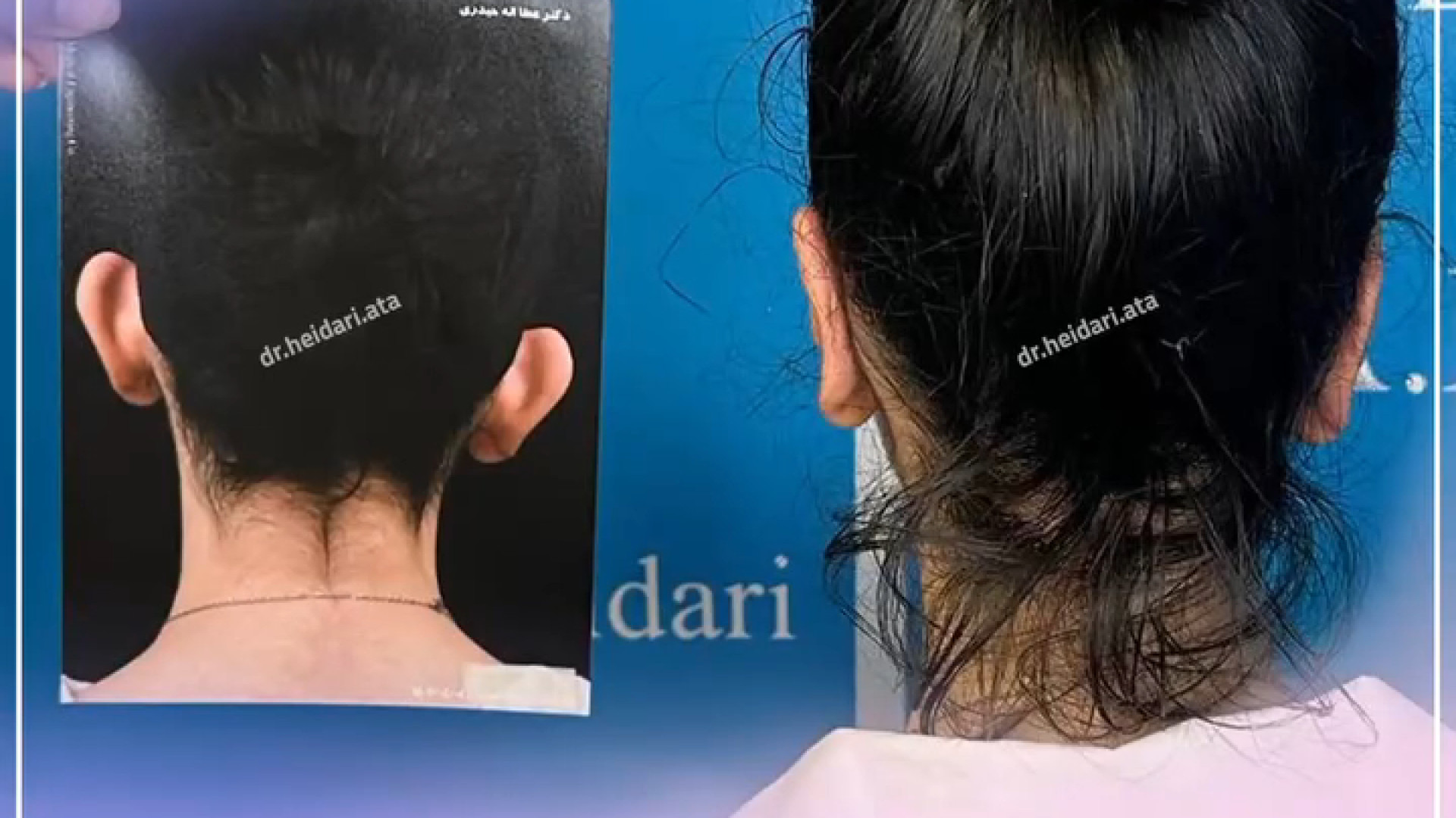 جراحی گوش یا اتوپلاستی درمانی موثر برای برجسته بودن گوش راوالیزوماب