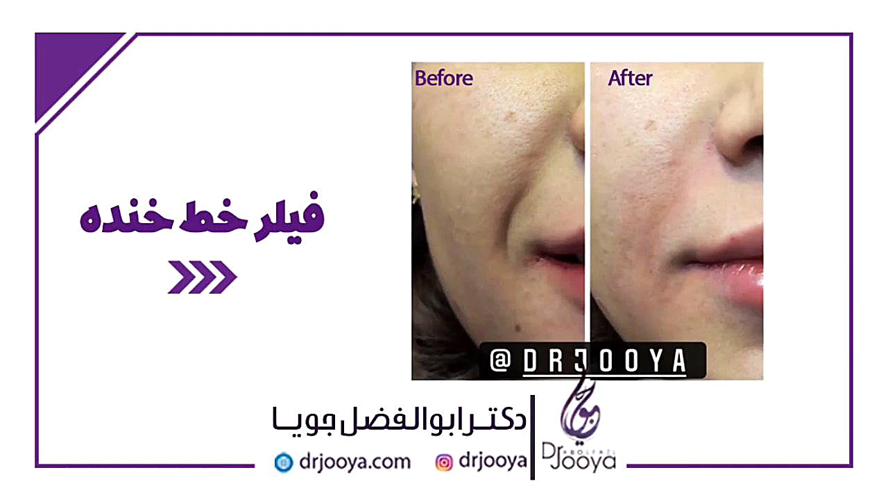 نمونه کار تزریق فیلر خط خنده | متخصص پوست اصفهان دکتر ابوالفضل جویا