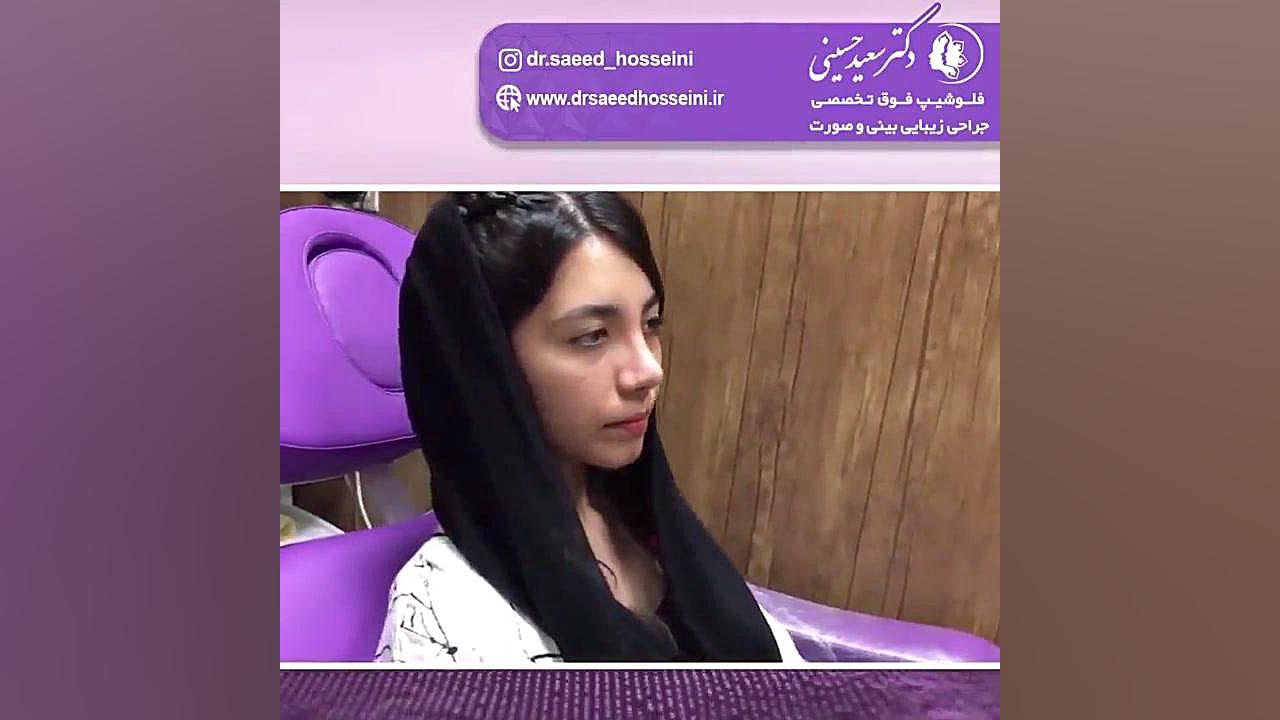 نتیجه جراحی بینی دو هفته بعد از عمل ماموپلاستی
