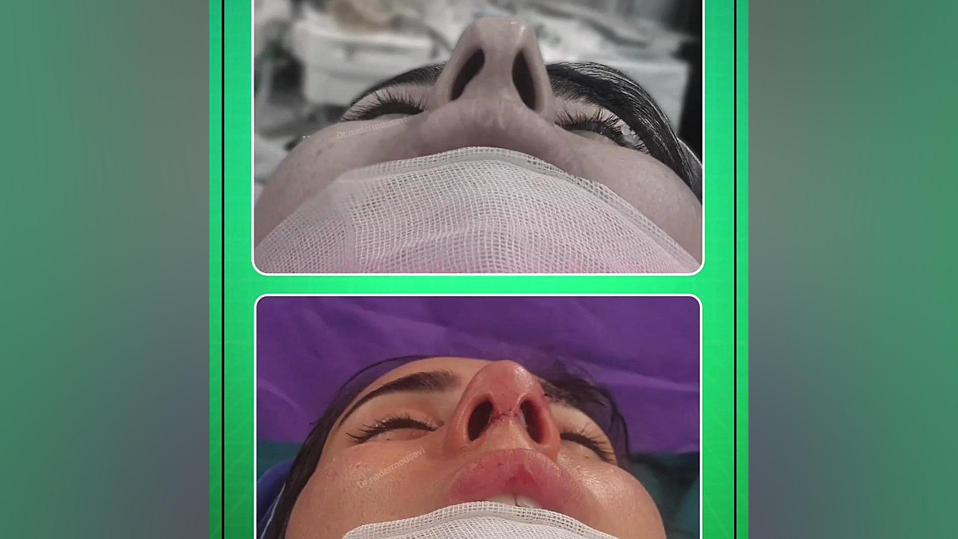 جراحی زیبایی بینی در گچساران ماکروسفالی