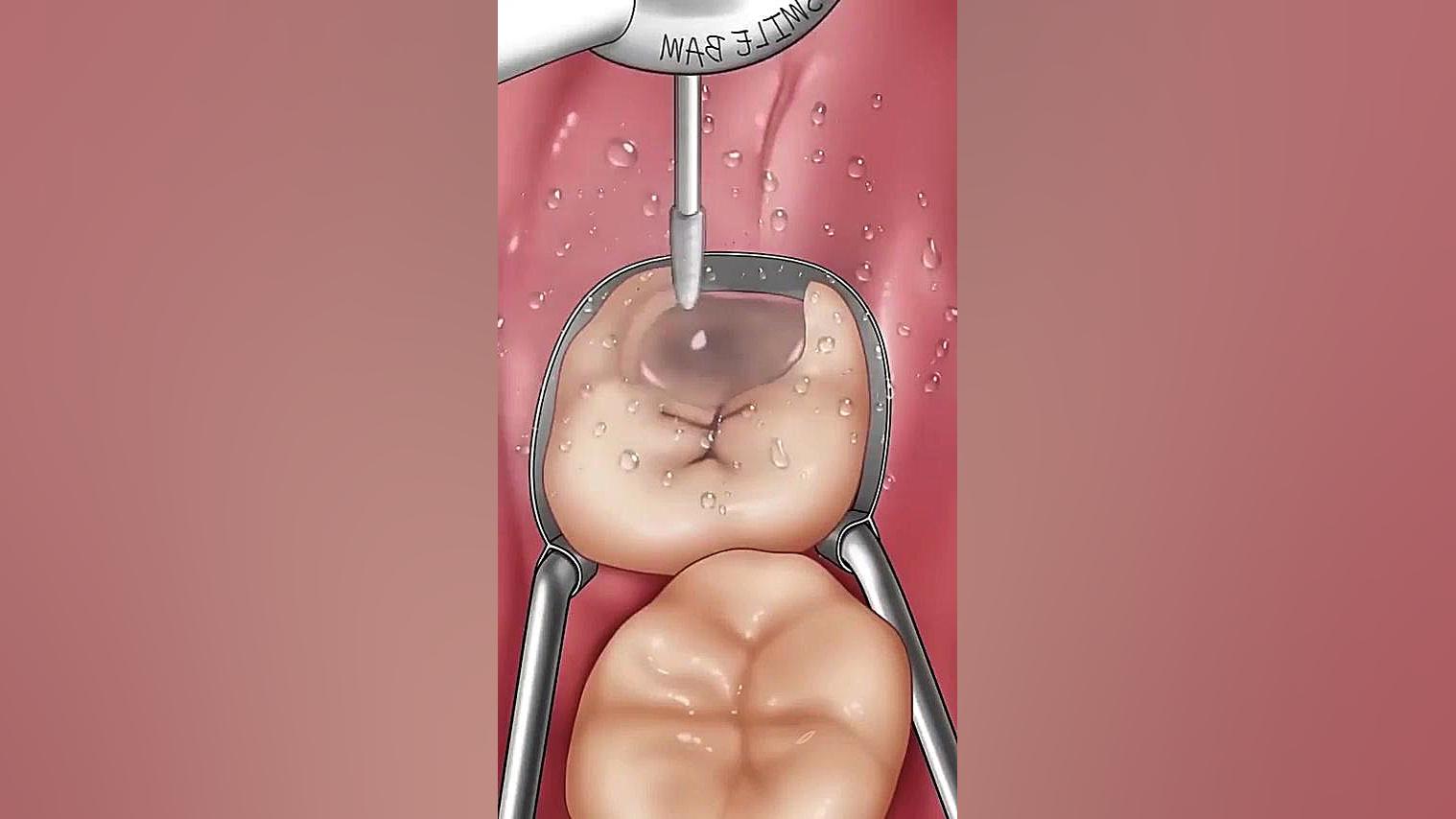 انیمیشن پر کردن دندان با کامپوزیت کربتوزوماب