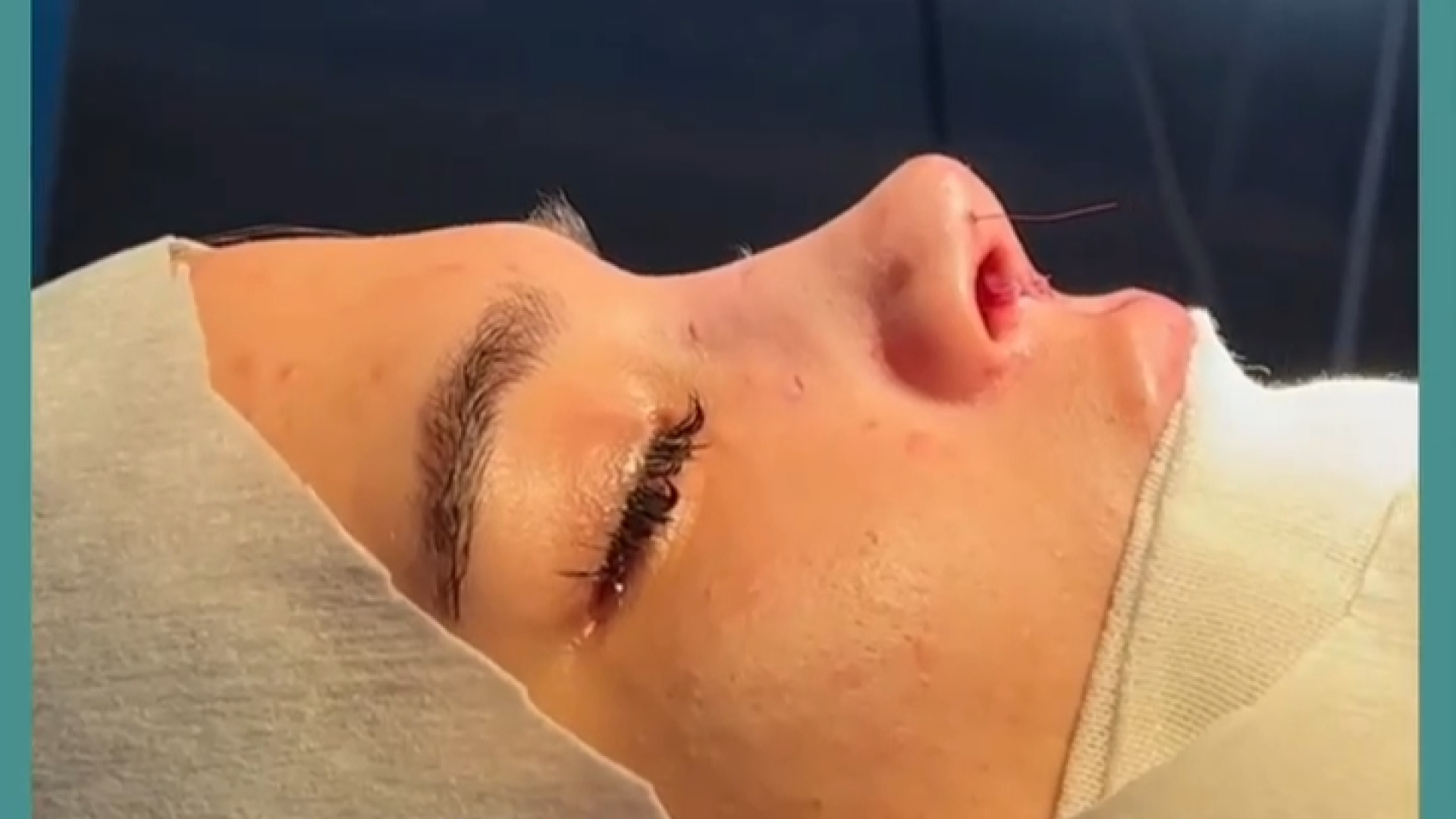 جراحی بینی عروسکی | دکتر اسماعیل زارع کابرگولین