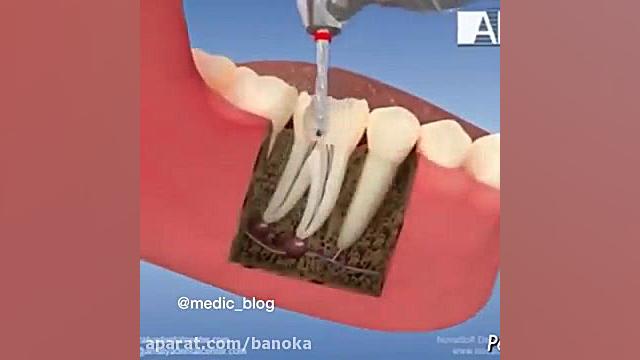 عصب کشی و پر کردن دندون (مجله بانوکا ) ASO Test