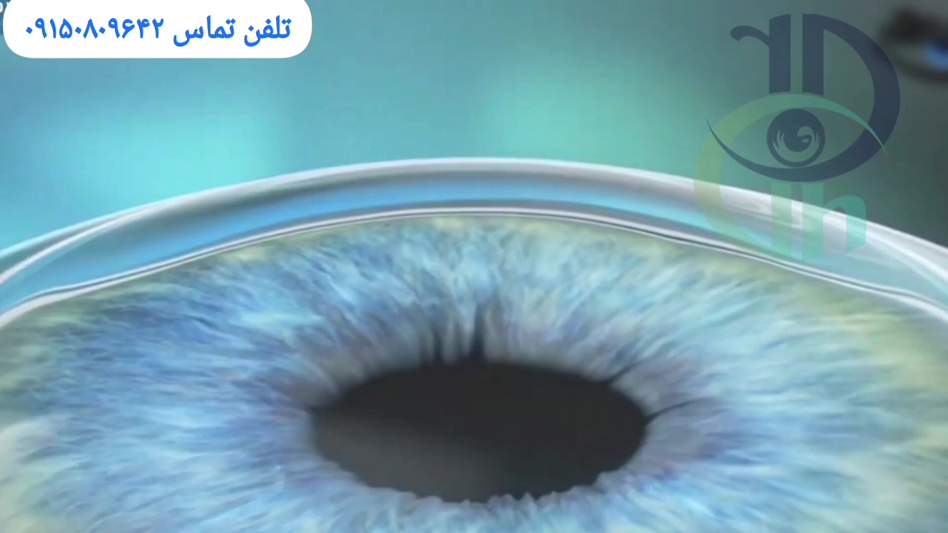 انواع عمل حذف عینک دکتر حسین قوام سعیدی