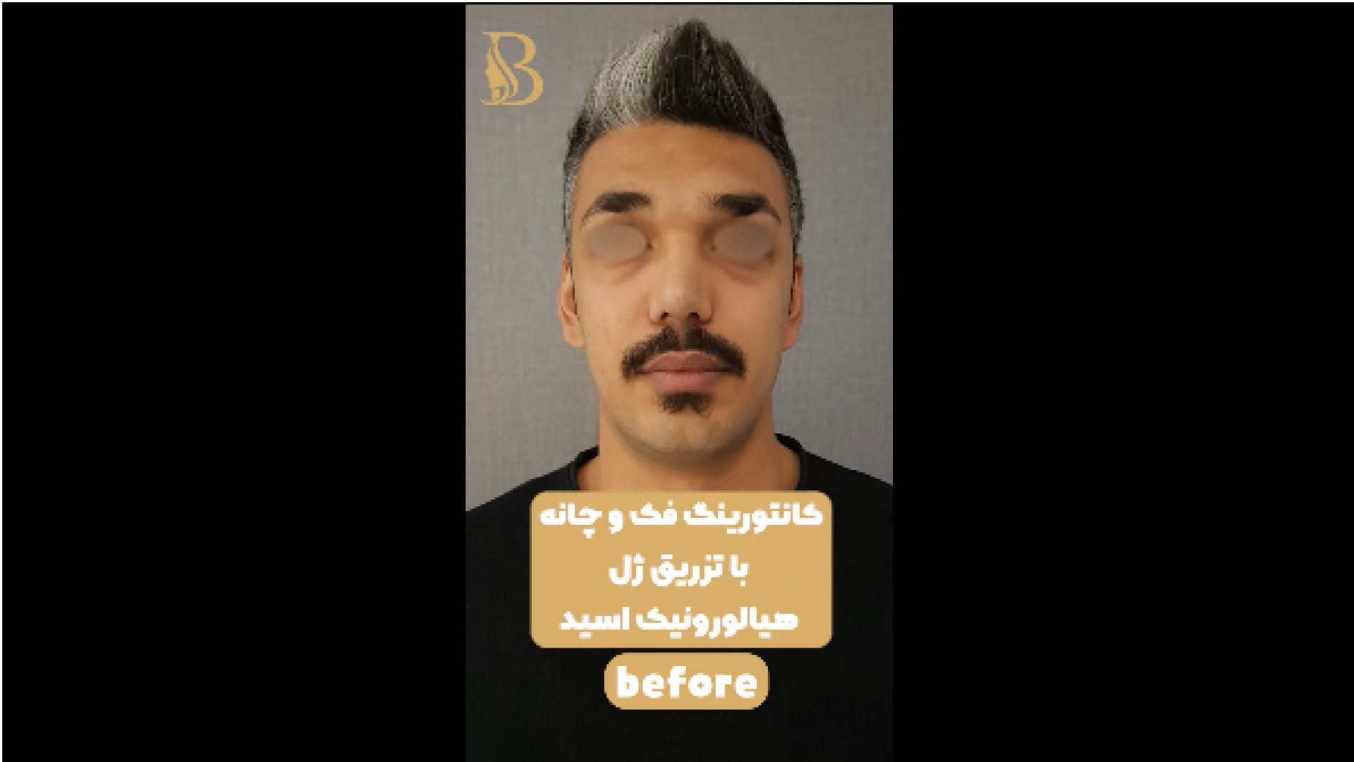 کانتورینگ فک و چانه دکتر سهیل برومند