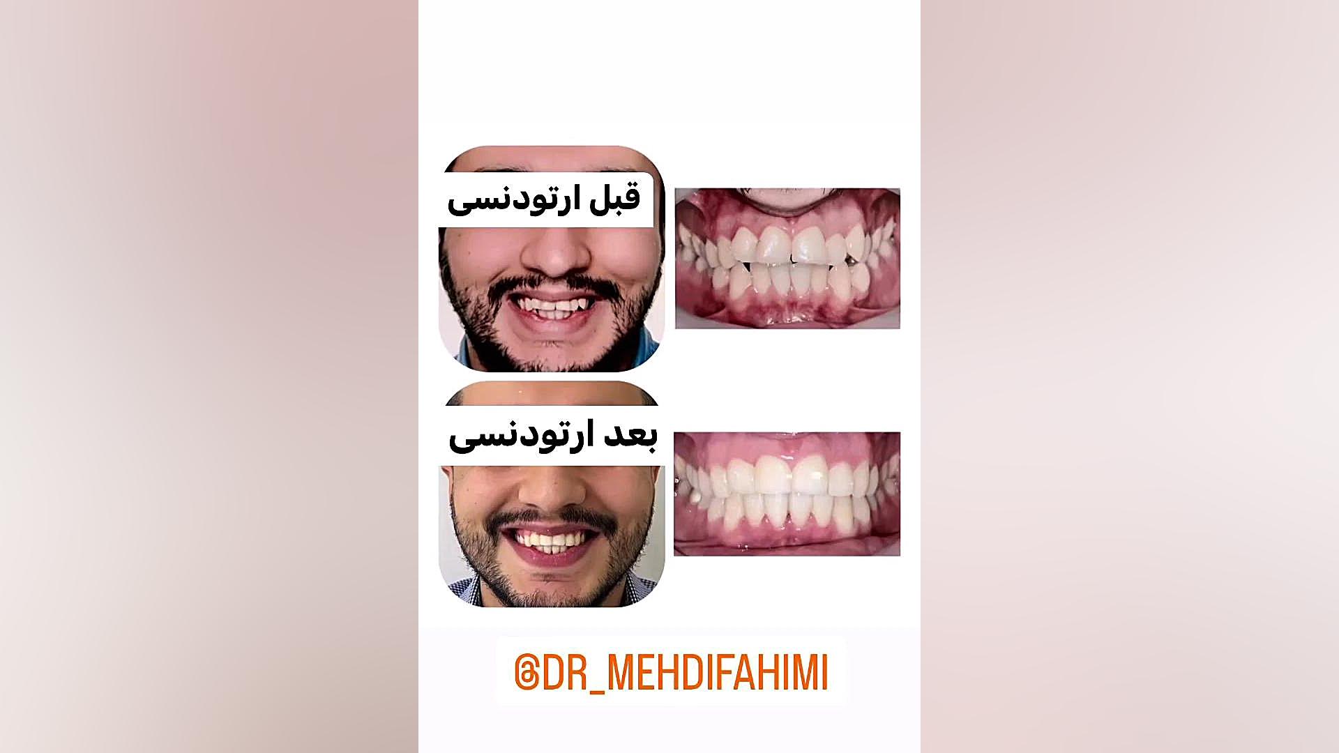 قبل و بعد ارتودنسی دکتر فهیمی دكتر مهدي فهيمي هنزائي