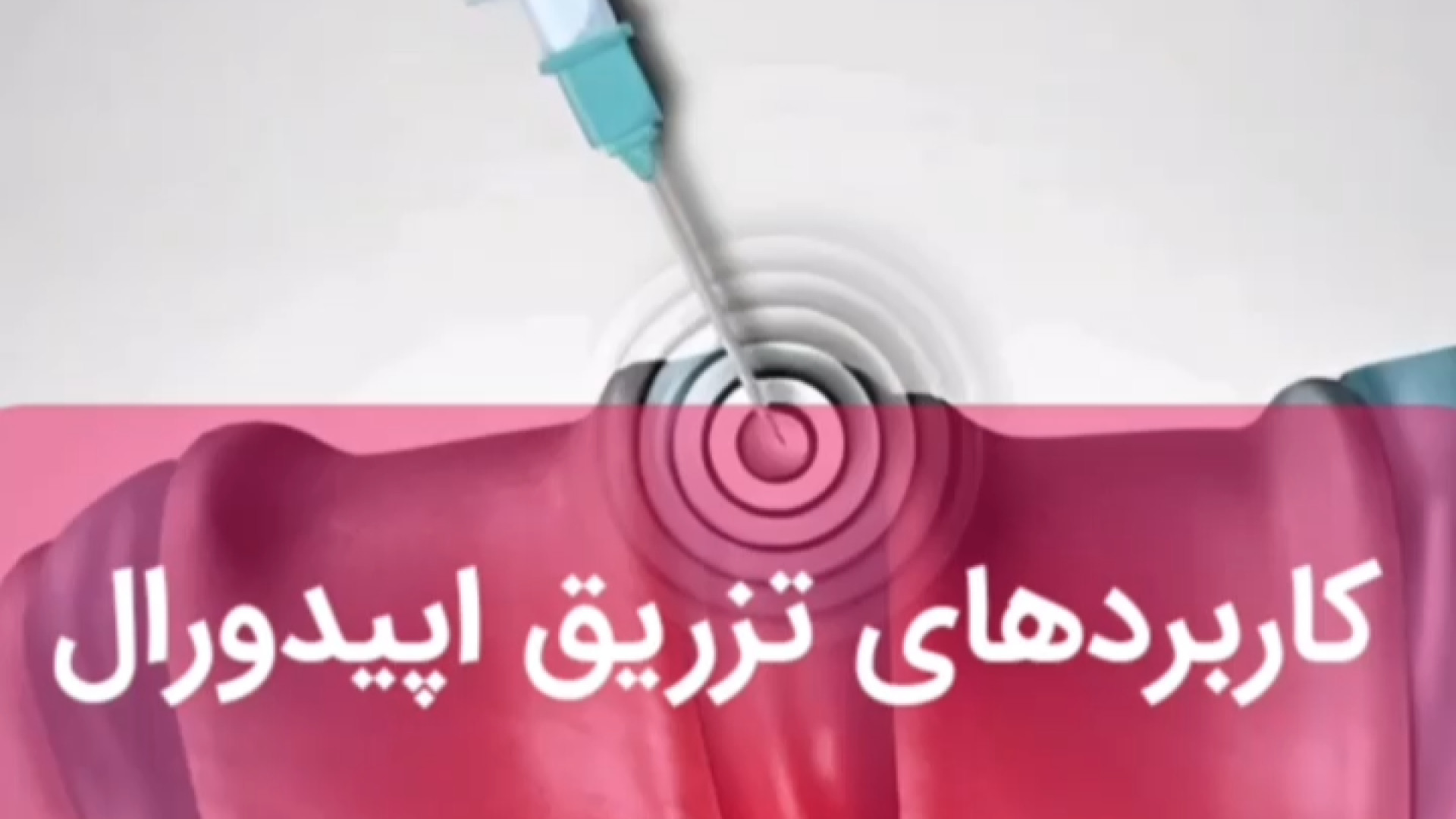 کاربرد های تزریق اپیدورال . کلینیک درد مهرگان ترمیم لبخند لثه‌ای