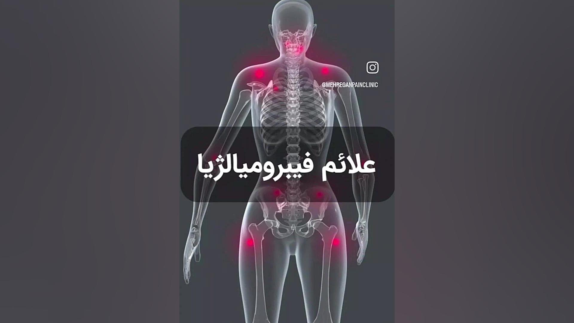 علائم سندروم فیبرومیالژیا . کلینیک درد مهرگان رفع غبغب