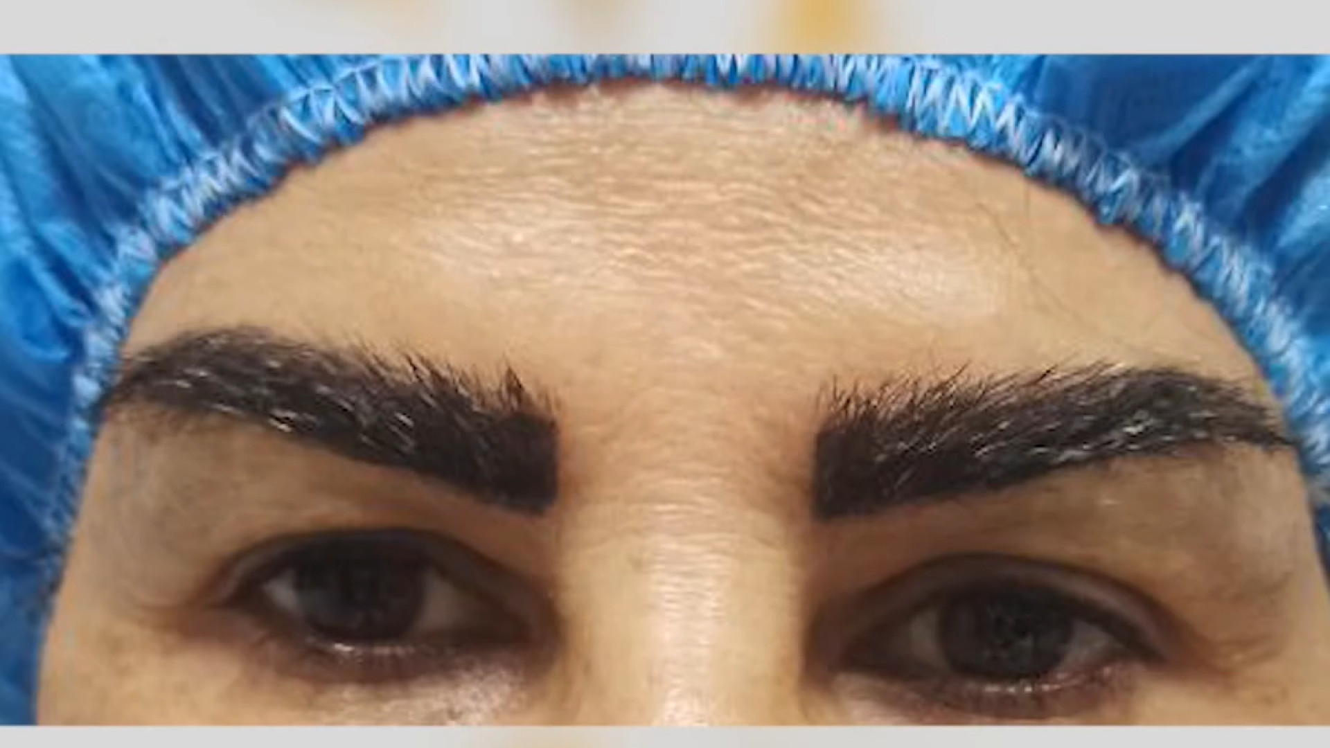 نمونه کار بلفاروپلاستی دکتر مریم فرخشاهی - پوست، مو و زیبایی