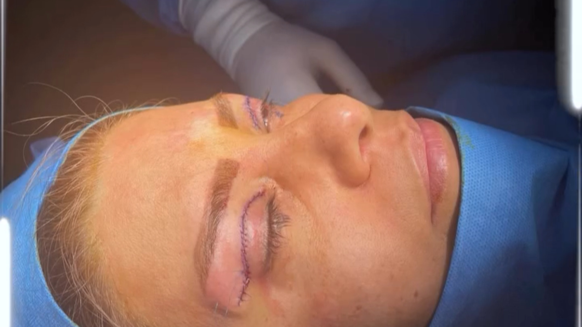 نمونه جراحی بلفاروپلاستی دکتر جواد رحمتی