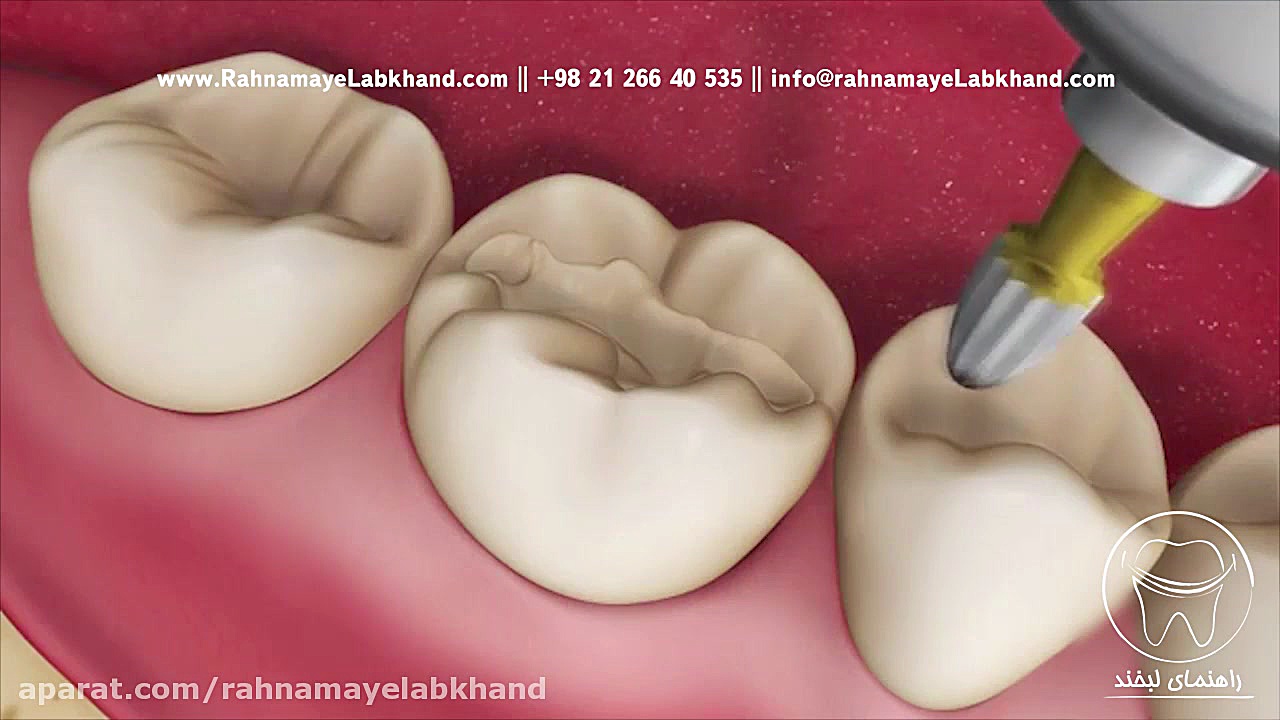 پر کردن دندان با مواد همرنگ دندان کلینیک دندانپزشکیایمونولوژی پیوند