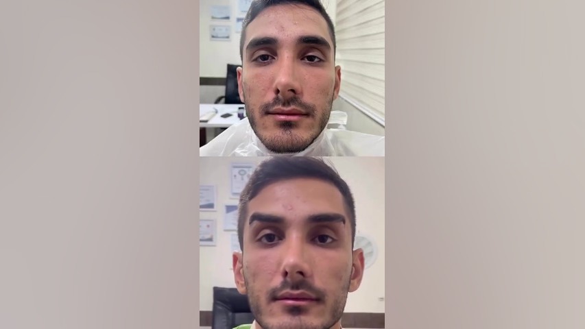 لیفت ابرو با نخ |دکتر میعاد مهدوی آزمون NanoString