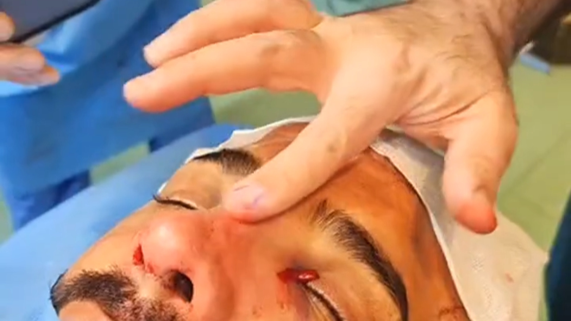 لیفت پیشانی و عمل بینی ترمیمی آتپازیب