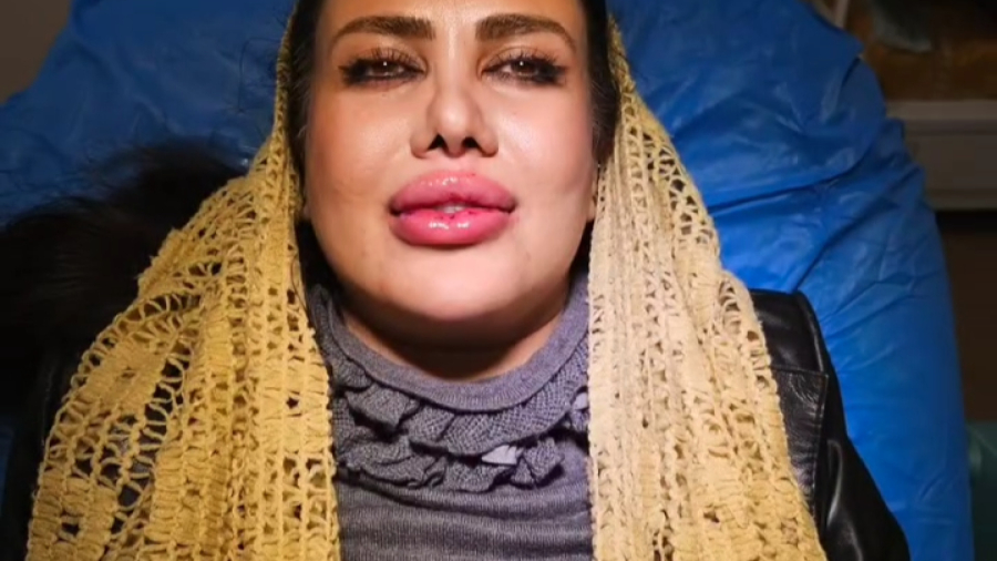 ️تزریق ژل پروفایلو لب و چانه ویکتوریا