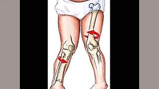 مشکلات عمده اسکلتی و زمینه افزایش قد دکتر اسماعیل توکلی متخصص بیماریهای غددو متابولیسم و د