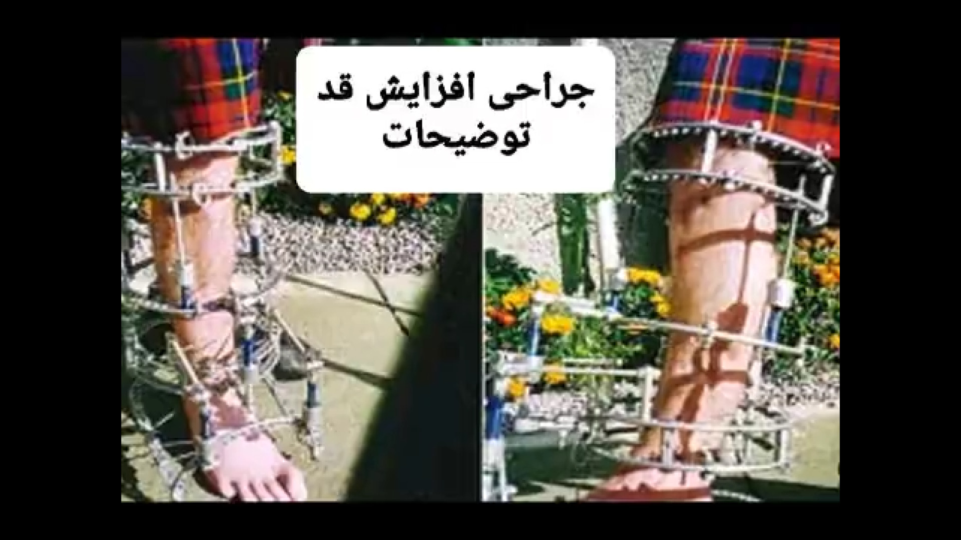 جراحیهای افزایش قد دوران نقاهت عوارض و منافع آن دکتر اسماعیل توکلی متخصص بیماریهای غددو متابولیسم و د