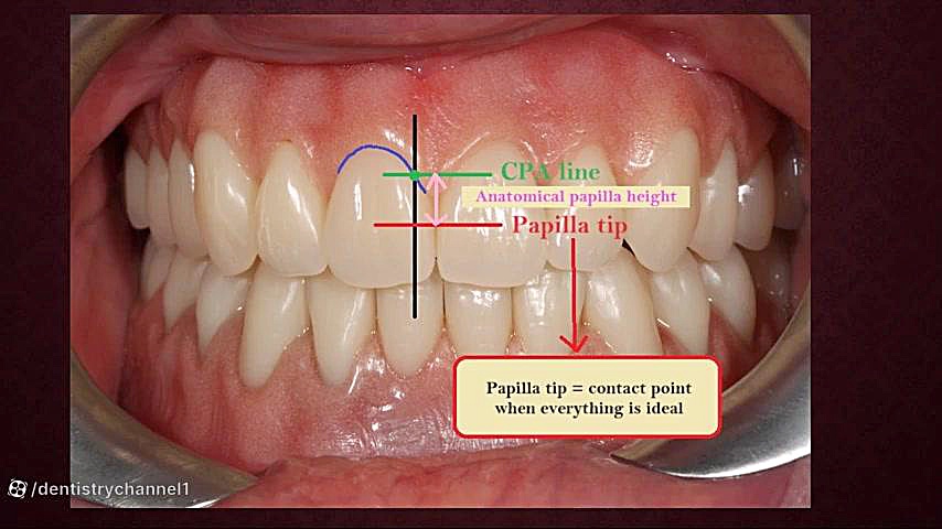 نحوه تعیین حداکثر خط پوشش ریشه(دکترمیرزاپور) برداشتن خال