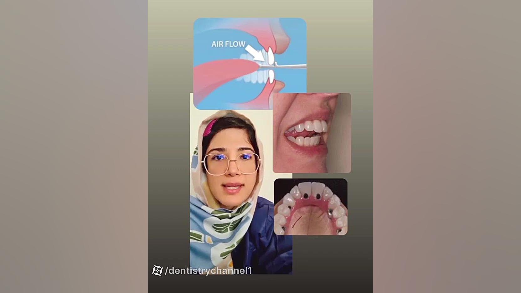 نکات آناتومیک جراحی ایمپلنت در قدام فک بالا(دکترمیرزاپور) Southern Blot
