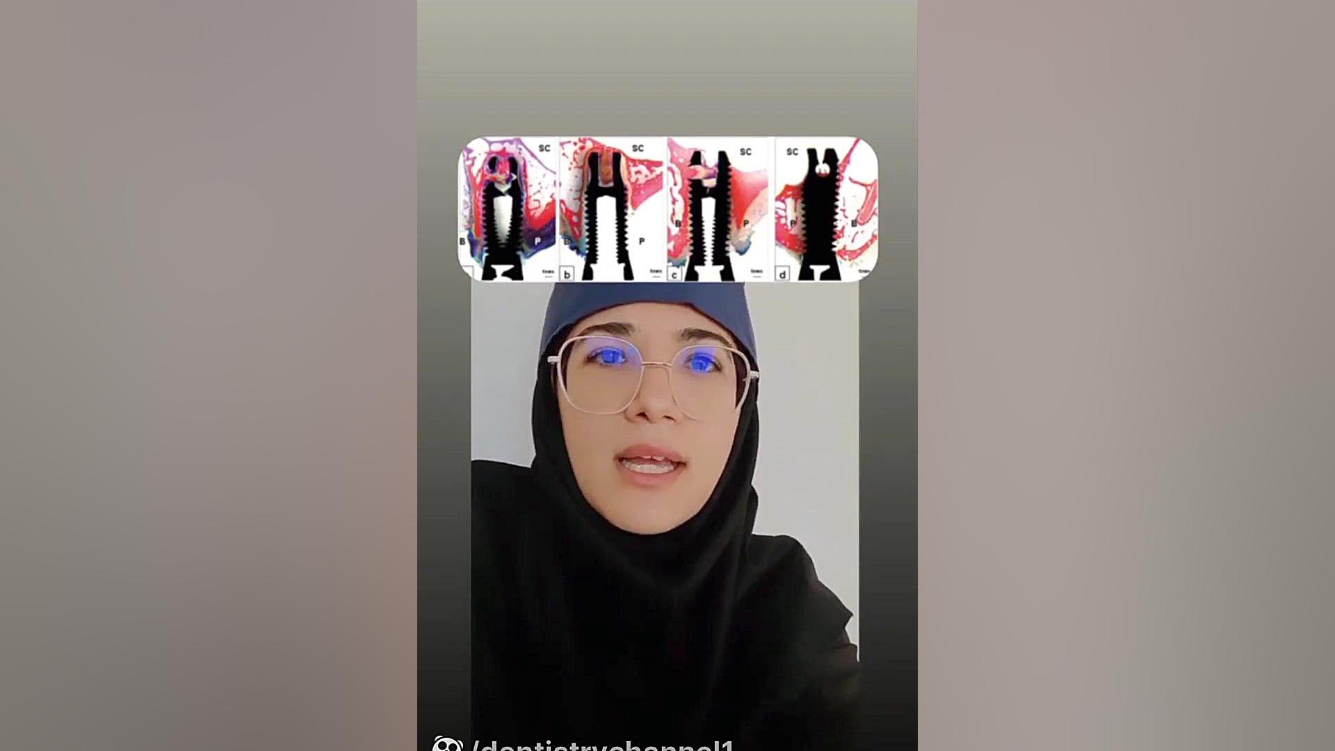 وارد شدن ایمپلنت دندانی در داخل سینوس ماگزیلاری(دکترمیرزاپور) زیبایی پوست