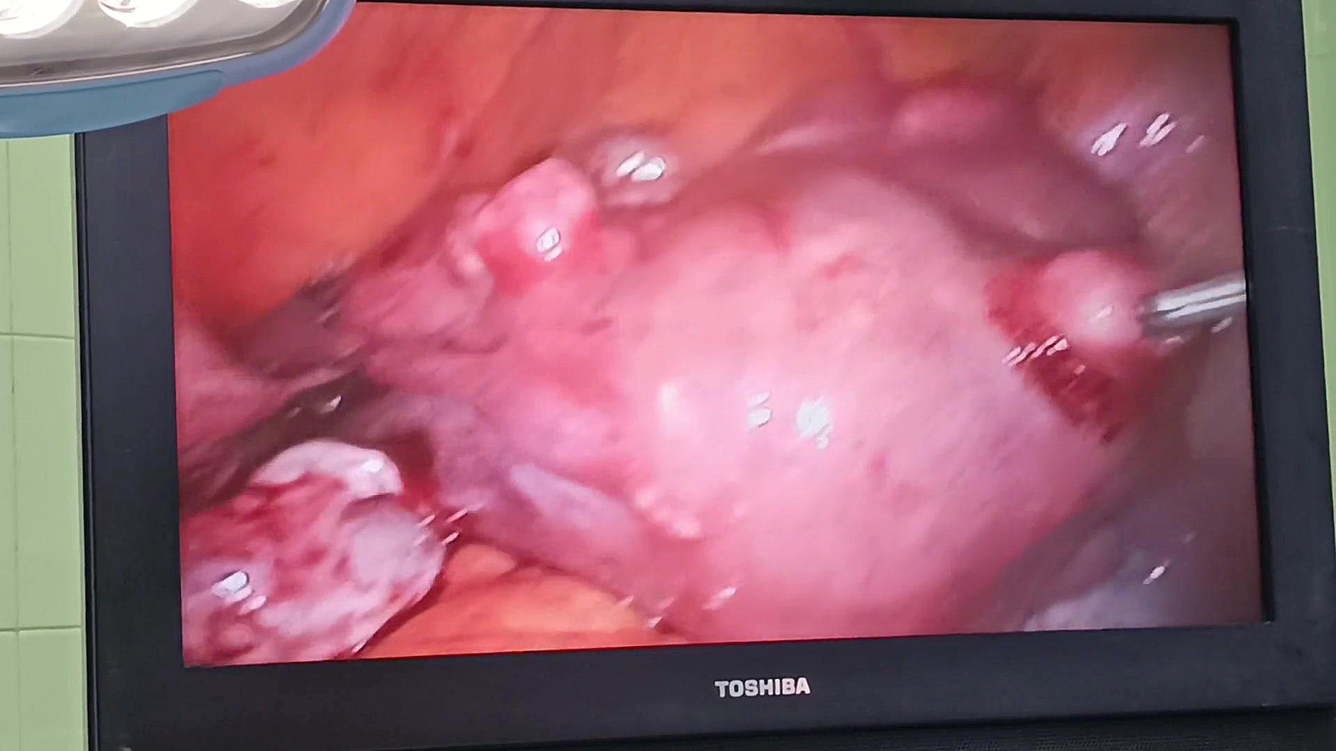 خارج کردن رحم با لاپاروسکوپی TLH دکتر فاطمه کریمی متخصص زنان و زایمان در قزوین