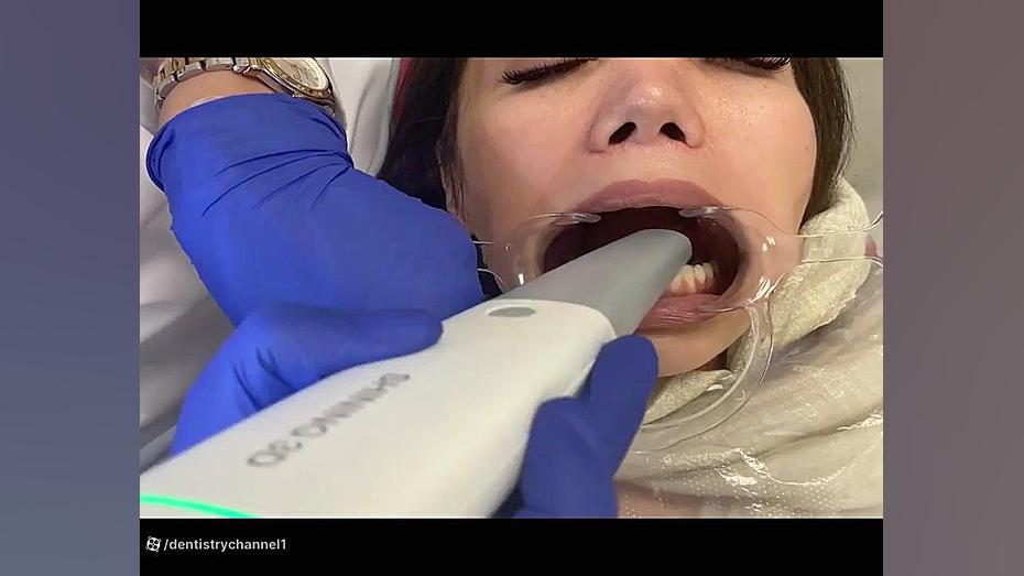 آموزش کار با اسکنر Shining 3D Aoralscan 3_ Scan Procedure (مقدماتی) پر کردن دندان