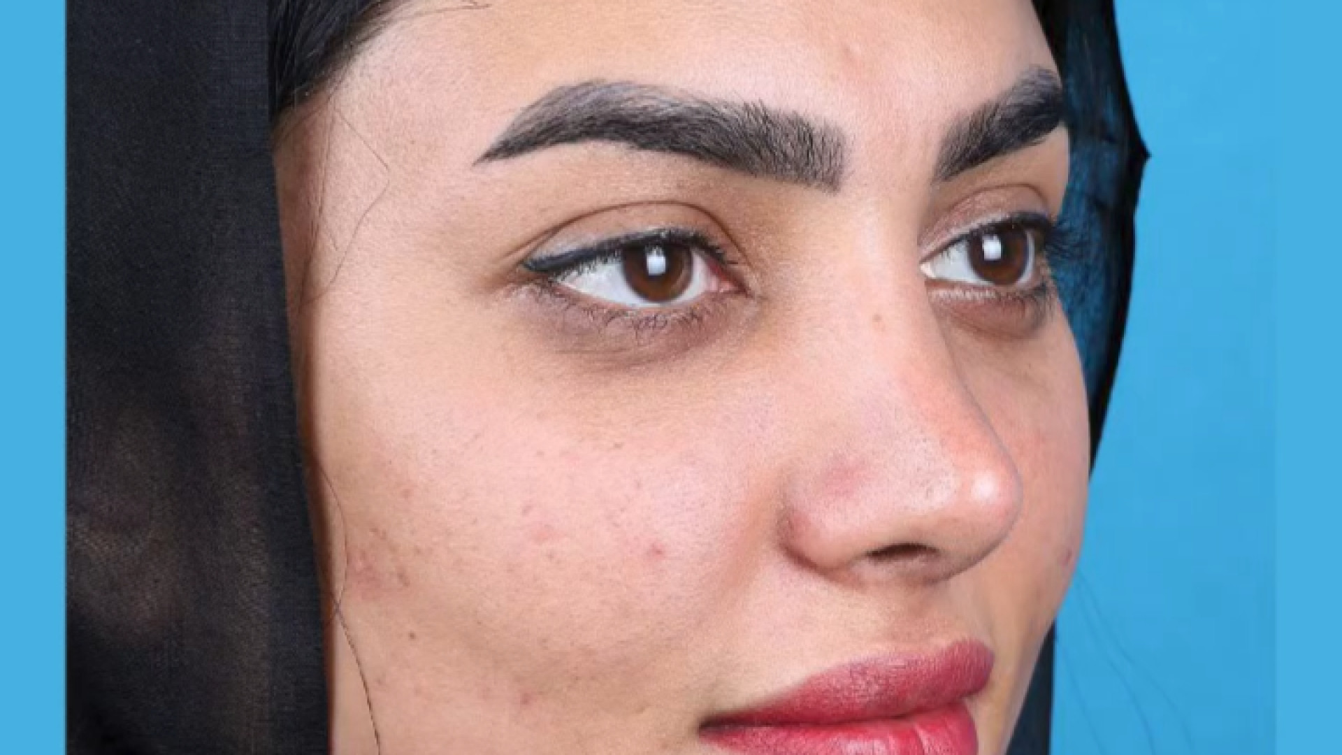 بینی گوشتی با پوستی ضخیم دکتر علی جمشیدی
