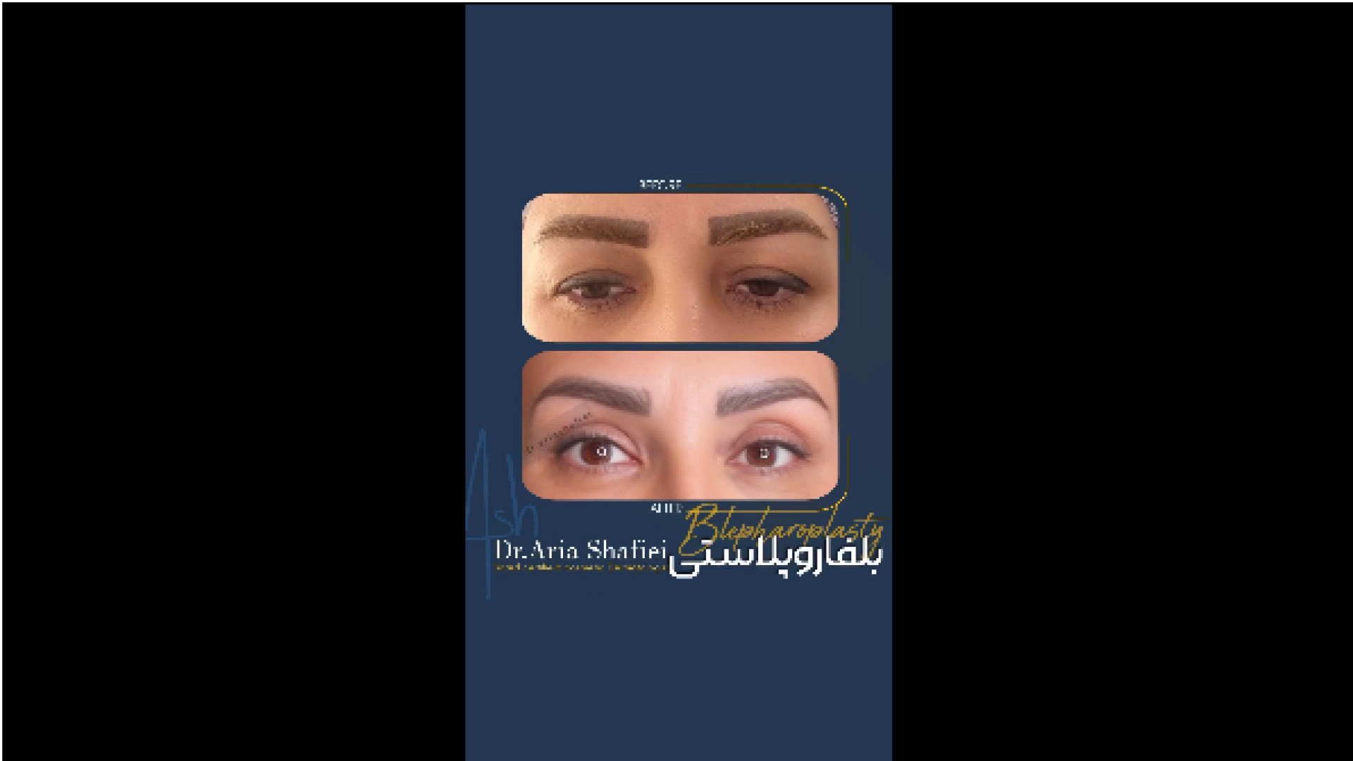 نتیجه بلفاروپلاستی دکتر آریا شفیعی