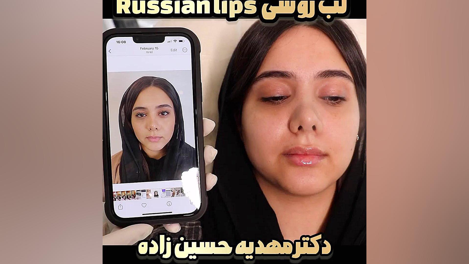 تزریق لب روسی،بهترین کلینیک زیبایی رشت دکتر مهدیه حسین زاده کلینیک زیبایی رشت دکتر مهدیه حسین زاده