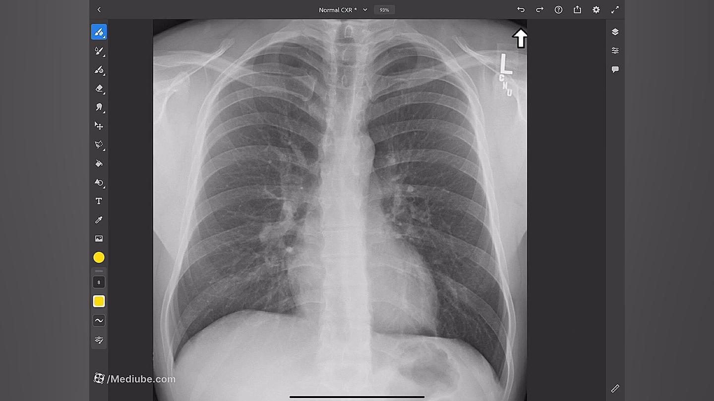پنوموتوراکس در مقابل کلاپس ریه اصلاح فرم صورت
