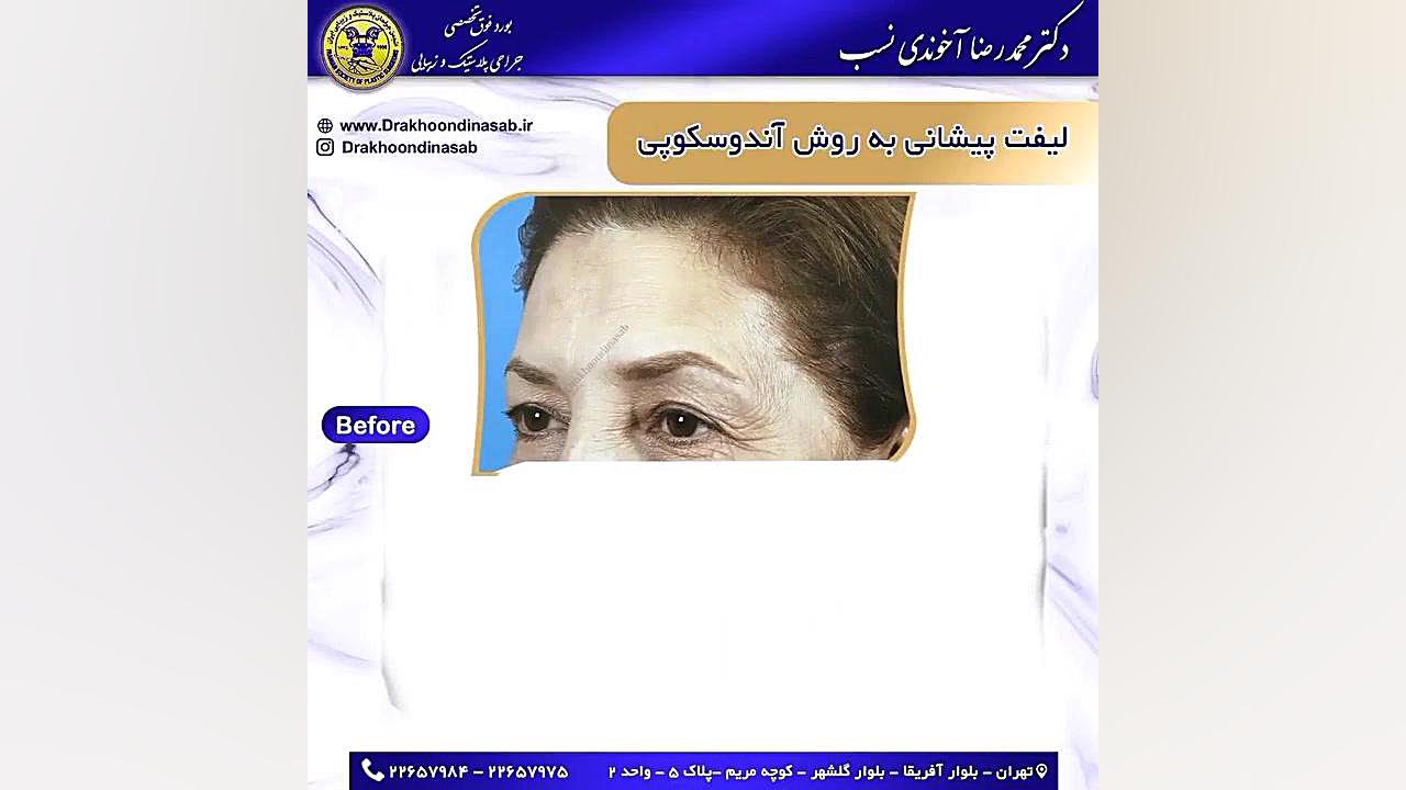لیفت پیشانی به روش آندوسکوپی لیفت ابرو
