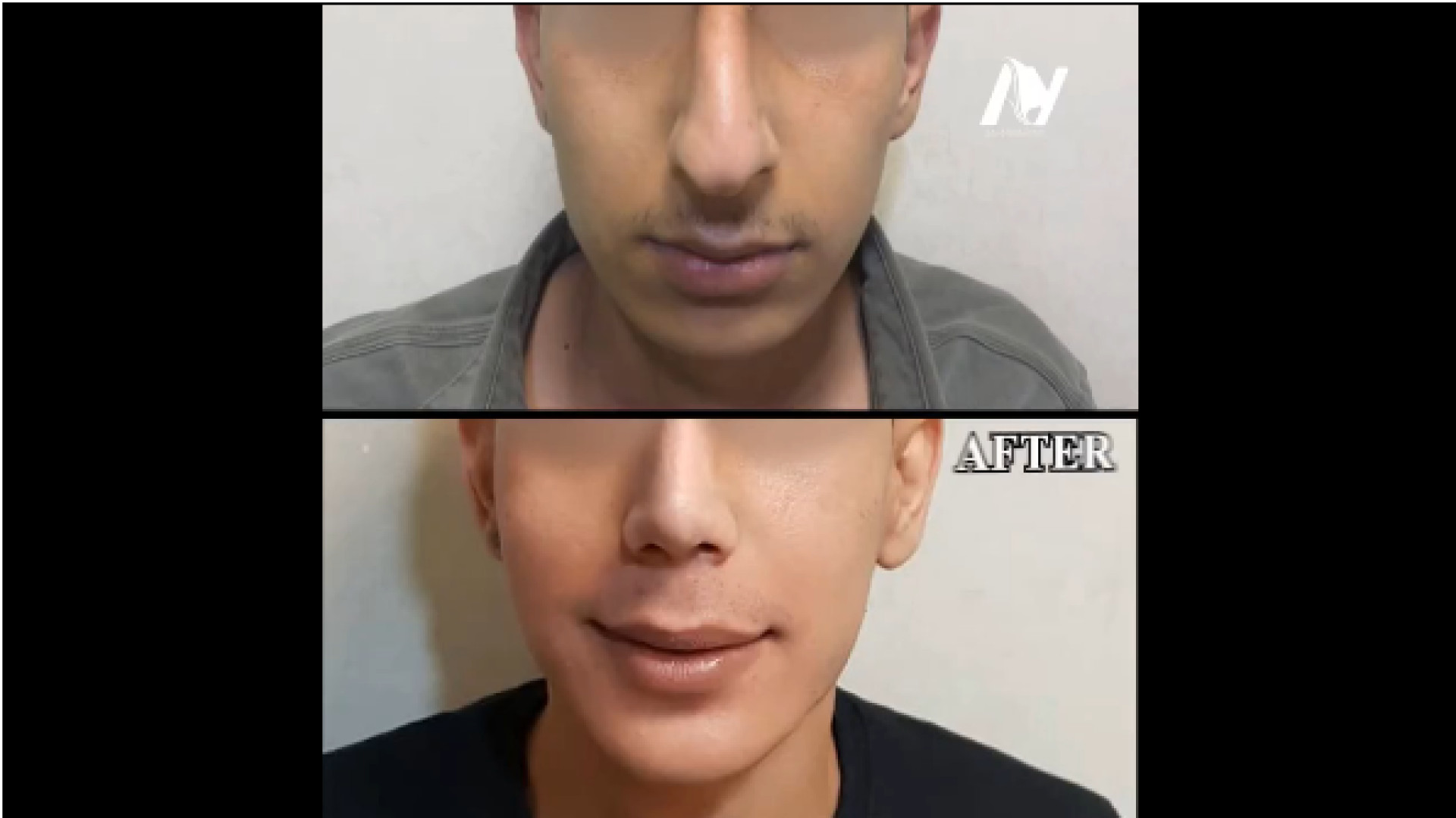 رینوپلاستی و ژنیوپلاستی همزمان دکتر محمودرضا اصحاب یمین - فوق تخصص پلاستیک