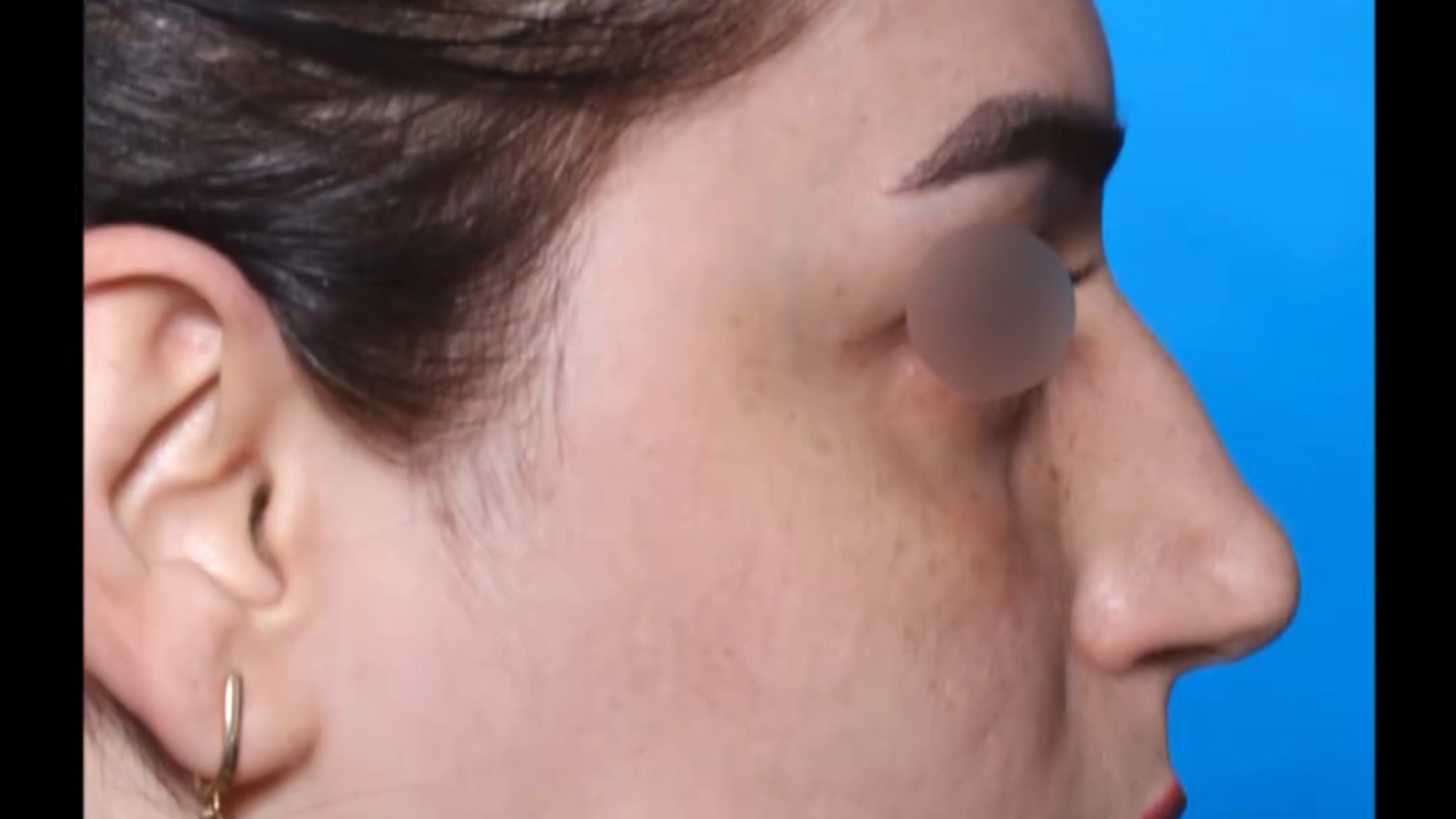 عمل زيبايى بينى دكتر كامران بابايى دکتر کامران بابایی