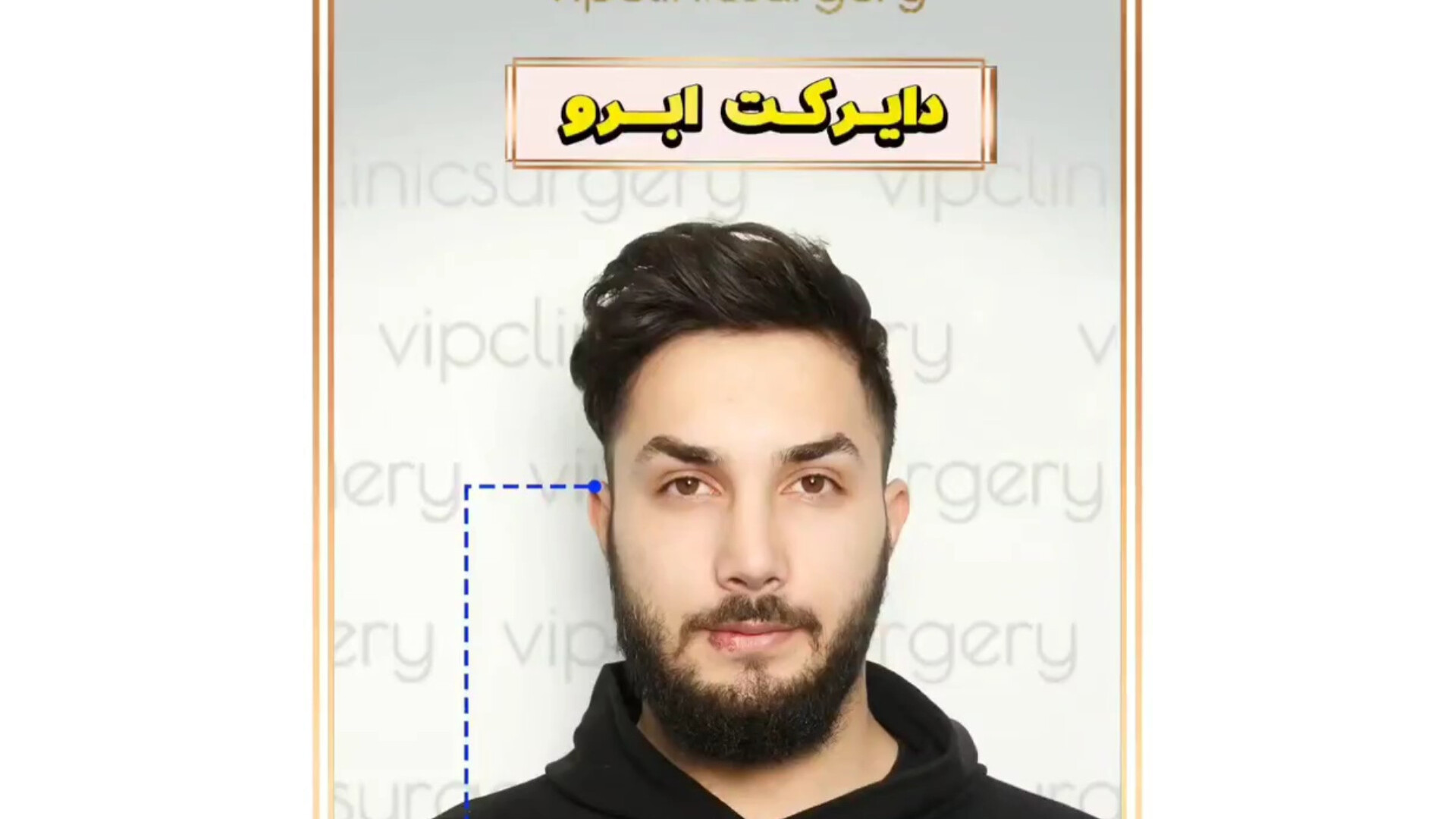 دایرکت لیفت ابرو طبیعی فوق‌العاده ریبوسیکلیب