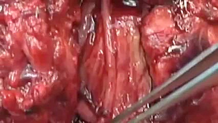 آملوبلاستوما جراحی فک و صورت بیماری سندرم فریمن شلدون