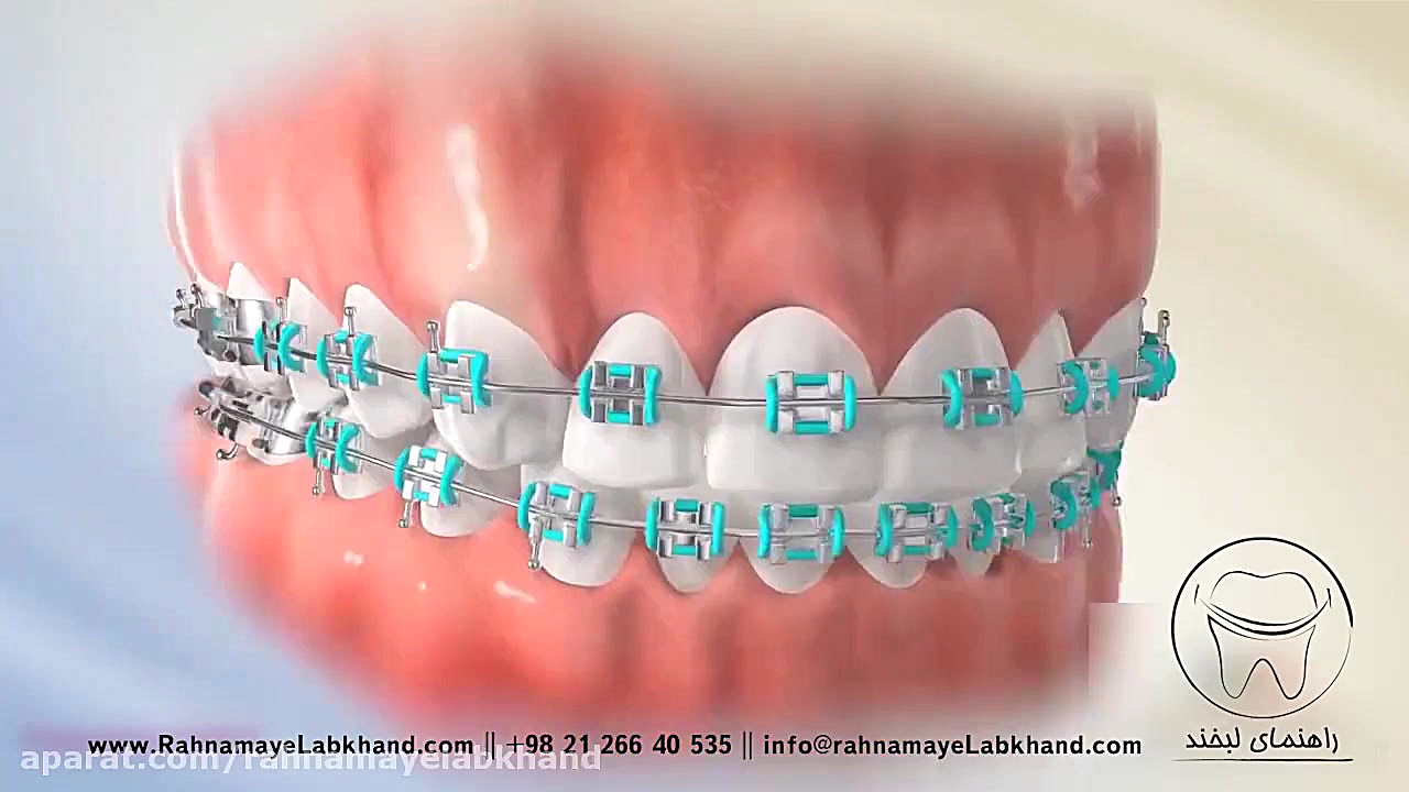 دندان نیش نهفته پر کردن دندان