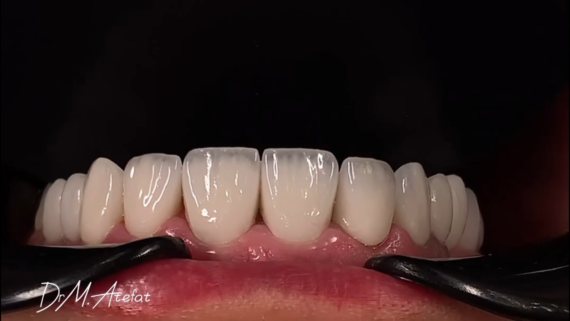 روکش و لمینت سرامیکی در اصفهان دکتر محمد عاطفت متخصص ترمیمی و زیبایی اصفهان