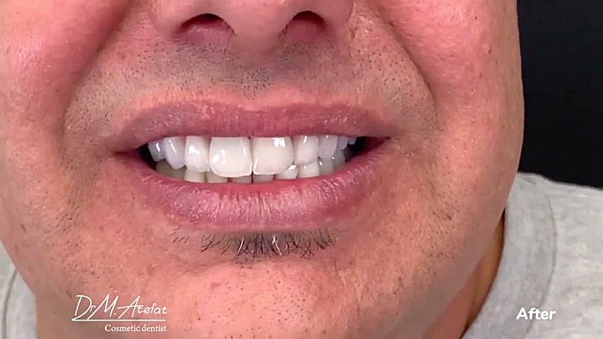 درمان ترکیبی روکش و لمینیت سرامیکی در اصفهان | ۰۹۱۳۰۷۷۷۳۰۰ دکتر محمد عاطفت متخصص ترمیمی و زیبایی اصفهان