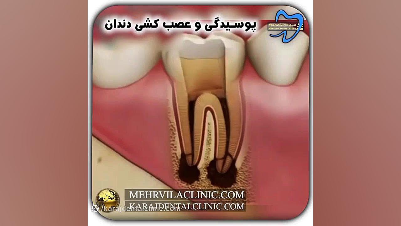 پوسیدگی و عصب کشی دندان بیماری آلبینیزم اوکولوتئوکوتانئوس