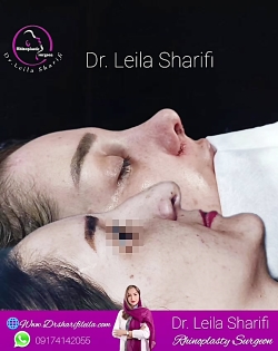 نمونه عمل بینی زنانه در شیراز - دکتر لیلا شریفی